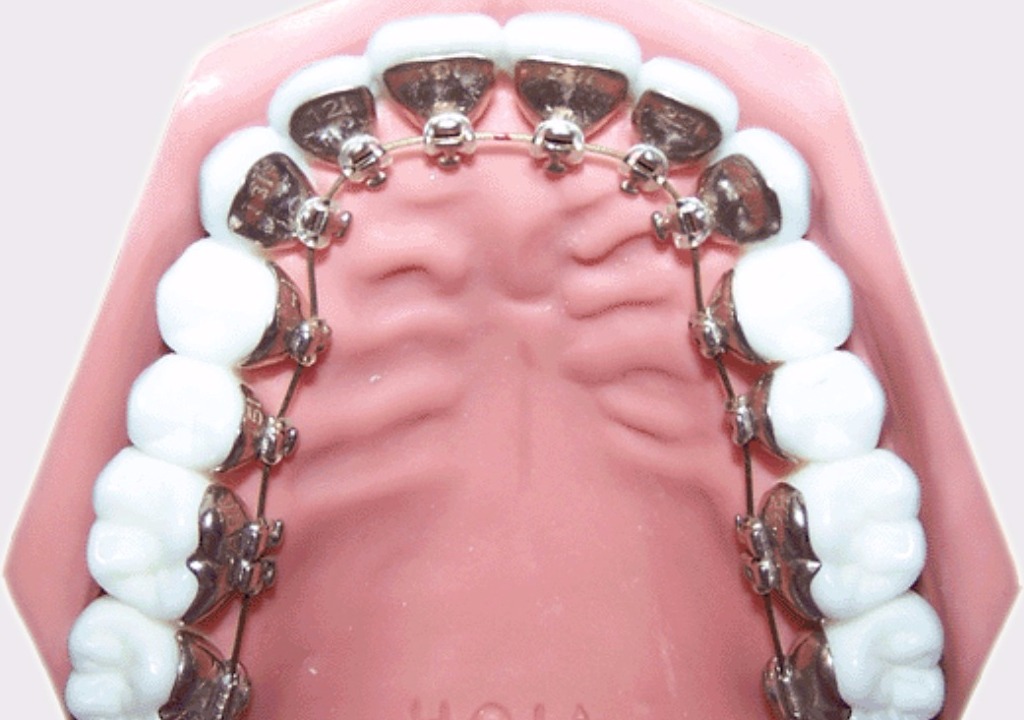 Ortodonti (Tel Tedavisi)