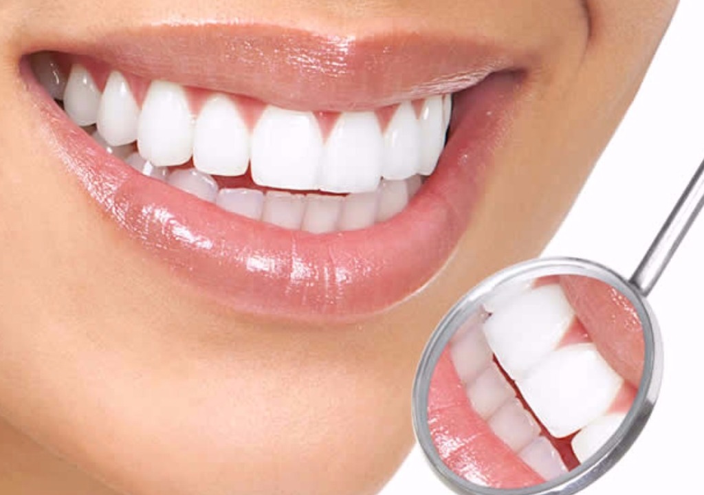 Tooth Whitening (Bleaching)