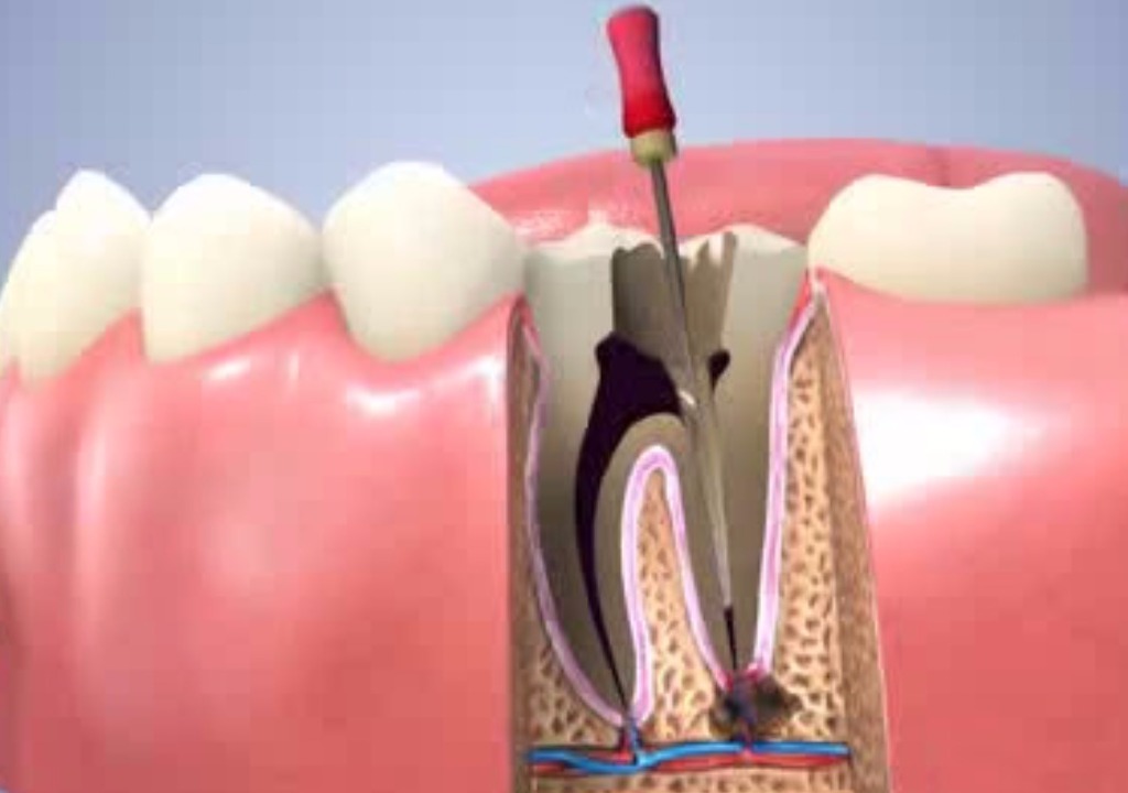 Endodontie (Kanalbehandlung)